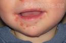 बच्चों में स्टामाटाइटिस: कारण, लक्षण और उपचार