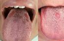 होंठ पर सिफलिस: रोग के कारण और लक्षण होंठ पर कठोर चांसर