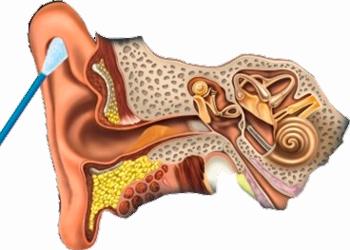 बच्चों के कान में वैक्स प्लग - कारण और छुटकारा पाने के तरीके बच्चों के कान में वैक्स प्लग कोमारोव्स्की