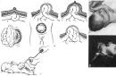 10 सप्ताह के भ्रूण में अम्बिलिकल हर्निया शारीरिक आंत्र हर्निया